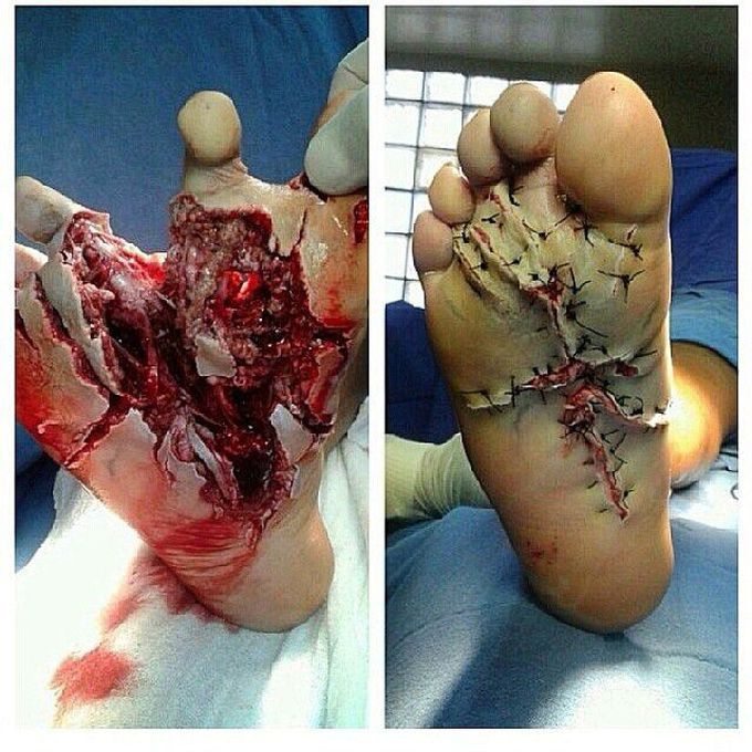 Extremely injured foot and emergent repair 👏
