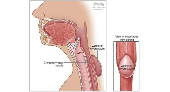 What causes Zenker’s diverticulum?