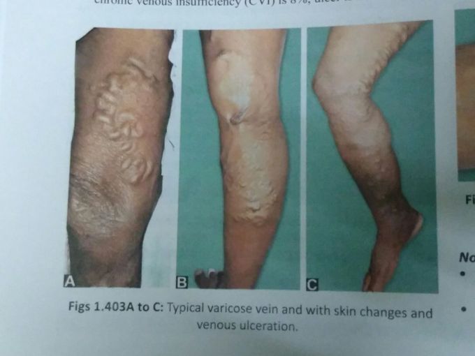 Typical varicose vein
