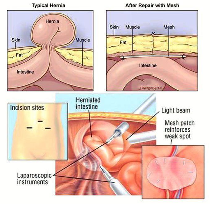 Hernia - MEDizzy