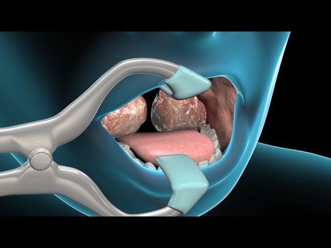 Tonsillectomy and Adenoidectomy: Animation