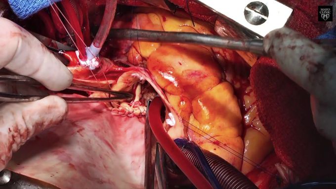 Aortic Root Enlargement