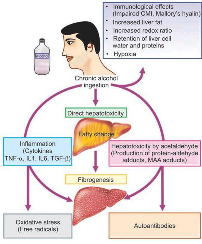 Alcoholic liver disease