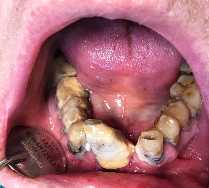 This 70-year-old patient NEVER brushed teeth in his life!! 