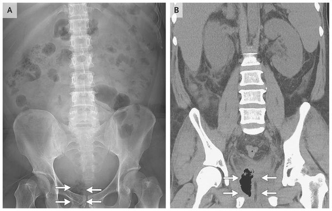 Emphysematous Prostatitis