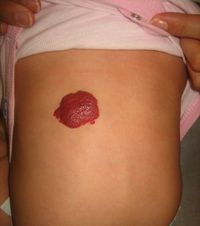 Infantile Hemangioma