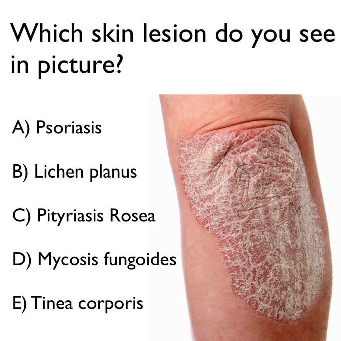 Identify the dermatological lesion