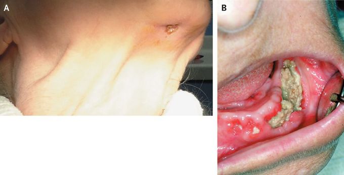 Halitosis and Sensory Loss