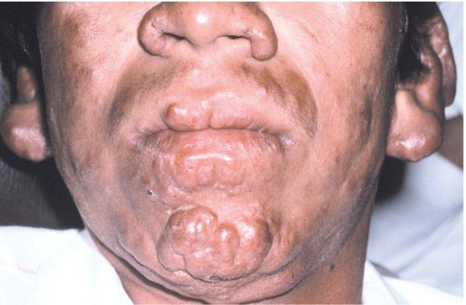 Multibacillary (Lepromatous) Leprosy.