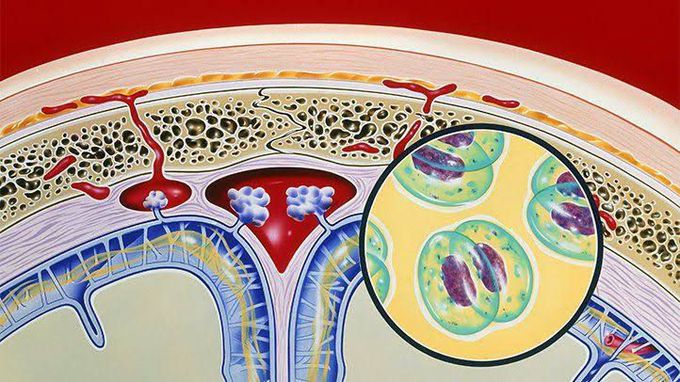 Bacterial meningitis Treatment