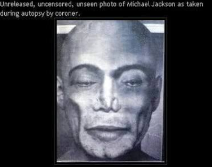 Autopsy photograph of Michael Jackson.