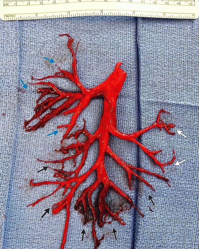 Blood clot from lung