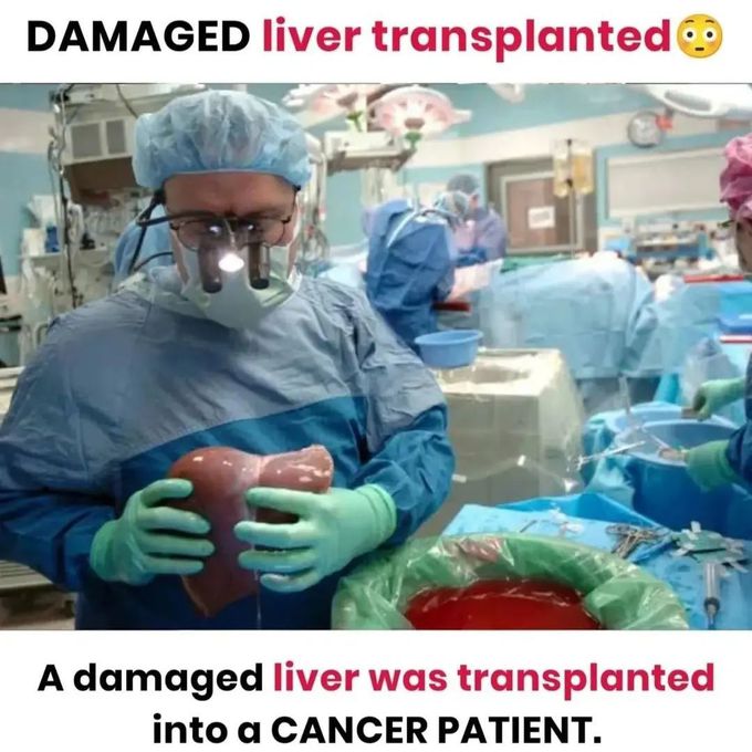 A damaged Liver Transplant!