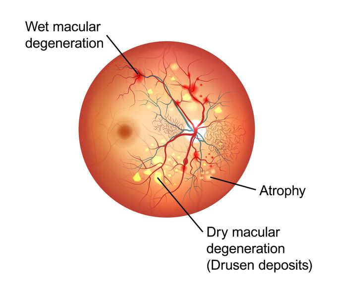 Age-Related Macular Degeneration.