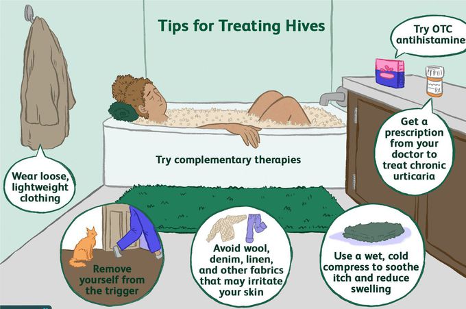 Treatment for hives