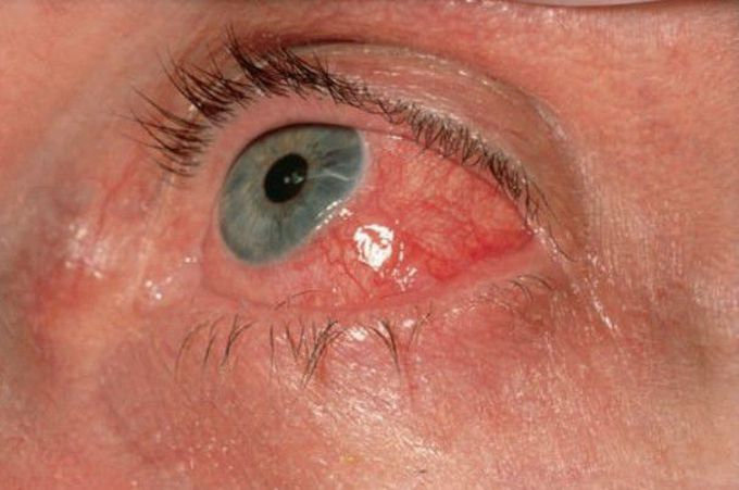 Ocular pemphigoid