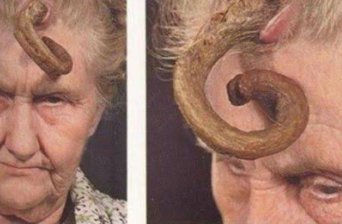 People live with this too... Cutaneous horn