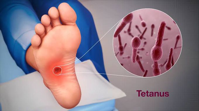 Treatment for tetanus