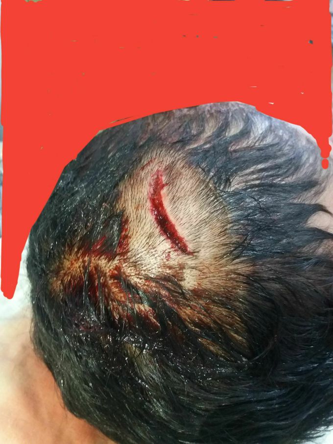 After trauma