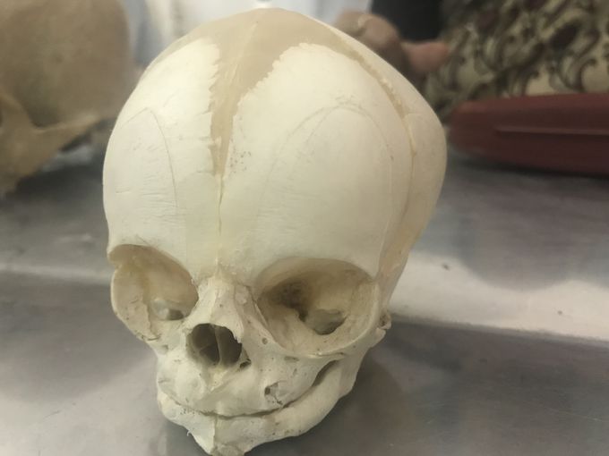Foetal skull