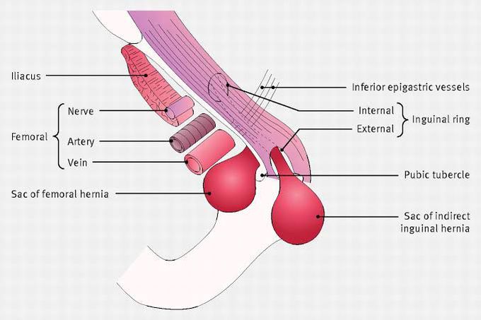 Femoral hernia anatomy 