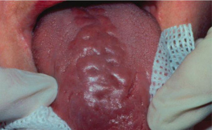 Chronic hyperplastic candidiasis