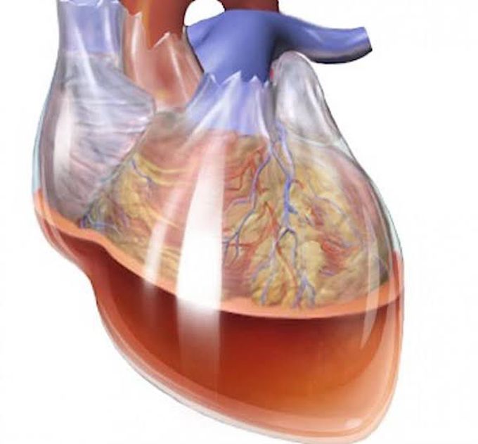 Cardiac tamponade