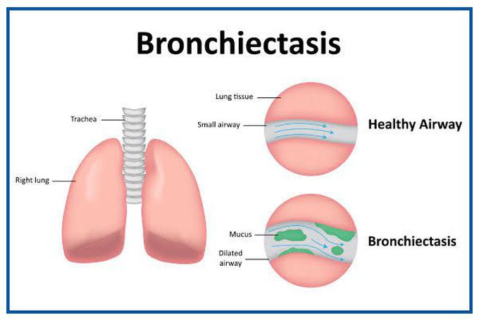 Treatment of broncheictasis
