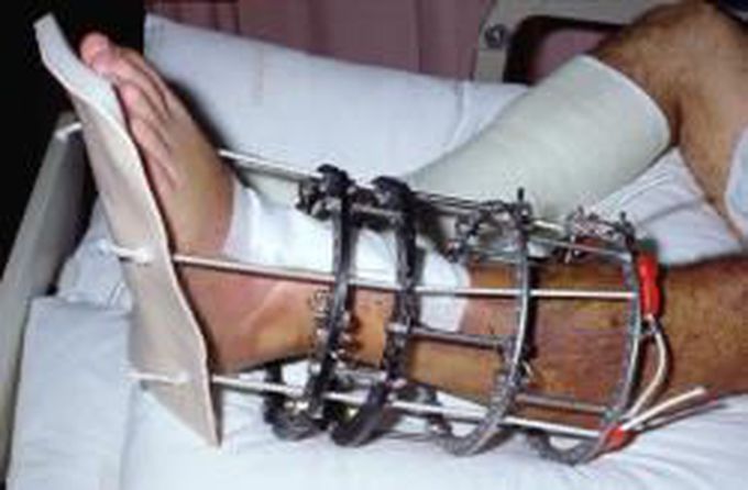 Ilizarov External Fixator