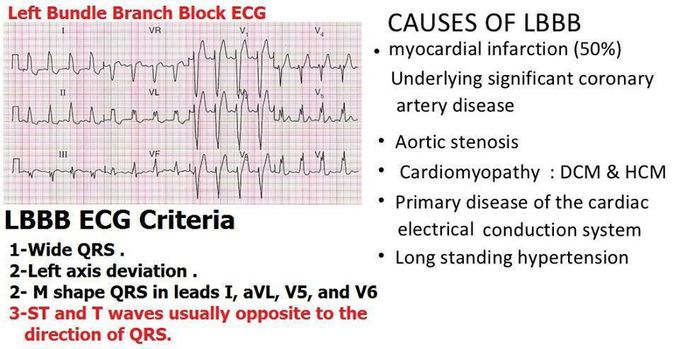 How to dx LBBB ?