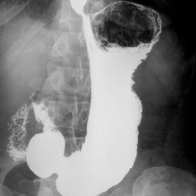 X-Ray examination of the stomach