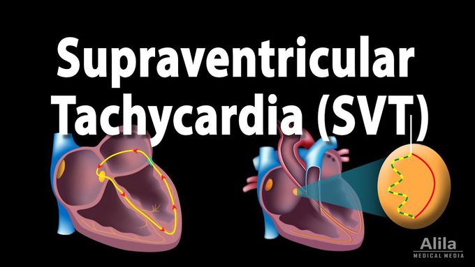 Supraventricular Tachycardia (Animation)