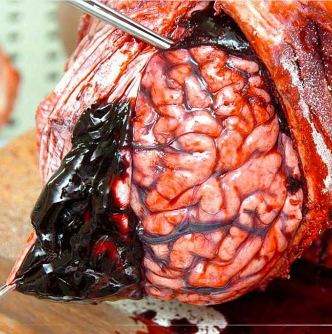 Huge subdural hematoma!