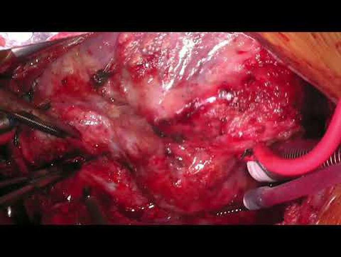 Staged Left Ventricular Recruitment for Biventricular Conversion in the Borderline Left Heart
