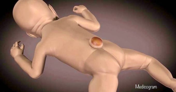 Spina bifida 