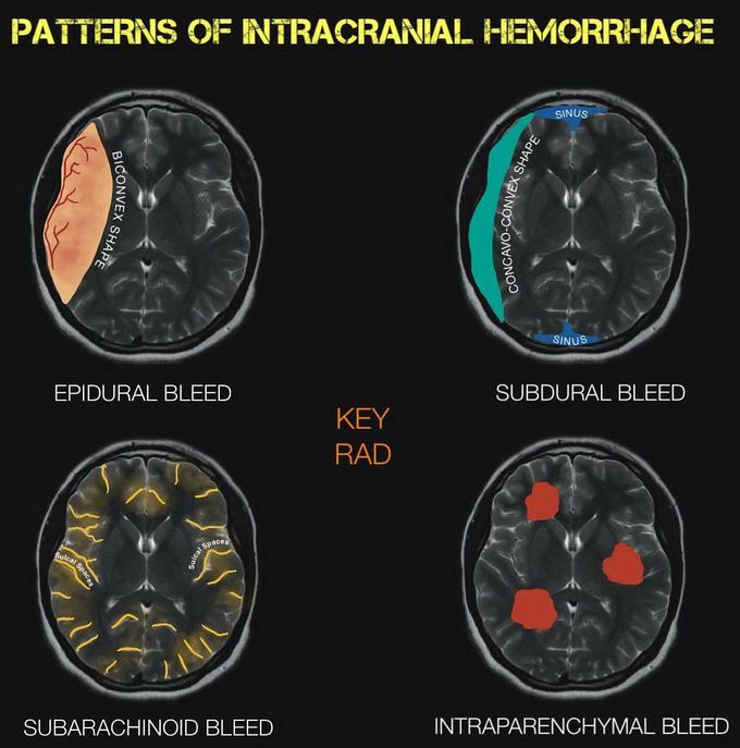 Patterns of Intracranial Hemorrhage