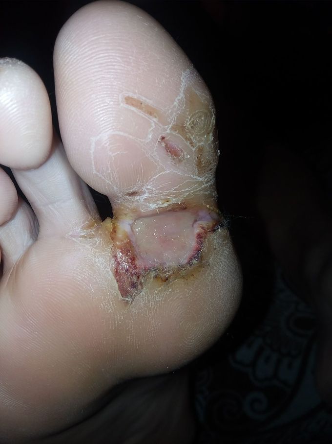 Almost 3 days later. Wound looking better!