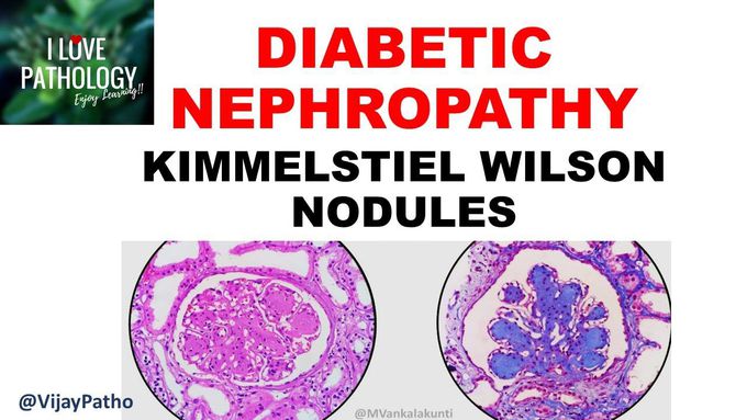 The pathogenesis of Diabetic nephropathy