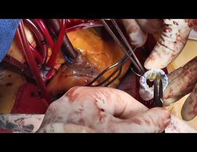 Modifications of Transatrial Transcatheter Mitral Valve Replacement Technique