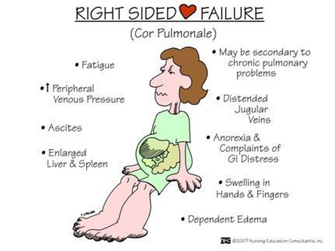 Heart failure symptoms