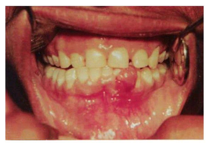 Inflammation hyperplasia