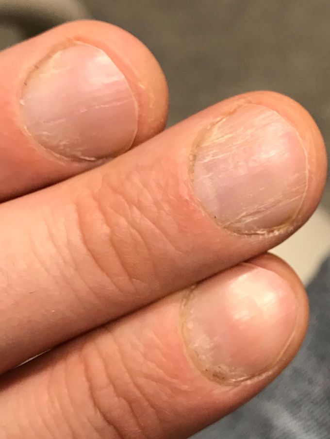 Cracked nails. Dry hands, nutritional deficiency or hypothyroidism