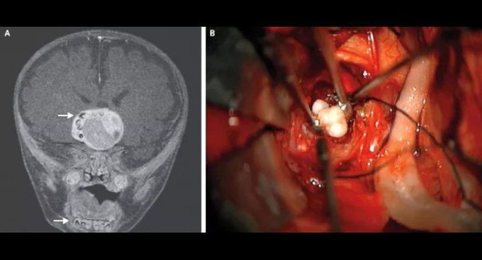 Teeth inside the brain of an infant!