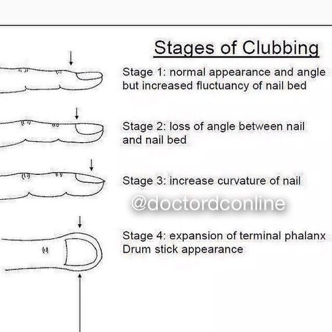 Stages of Clubbing