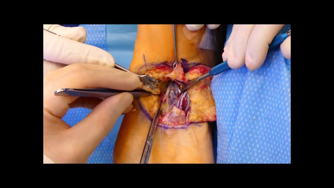 Stump Neuroma Revision Surgery Live surgery