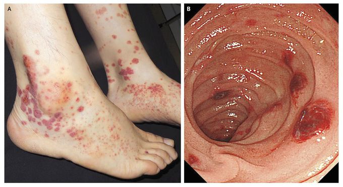Cutaneous and Gastrointestinal Purpura