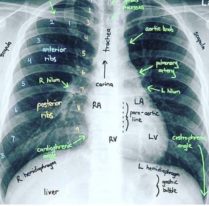 Normal chest X-ray