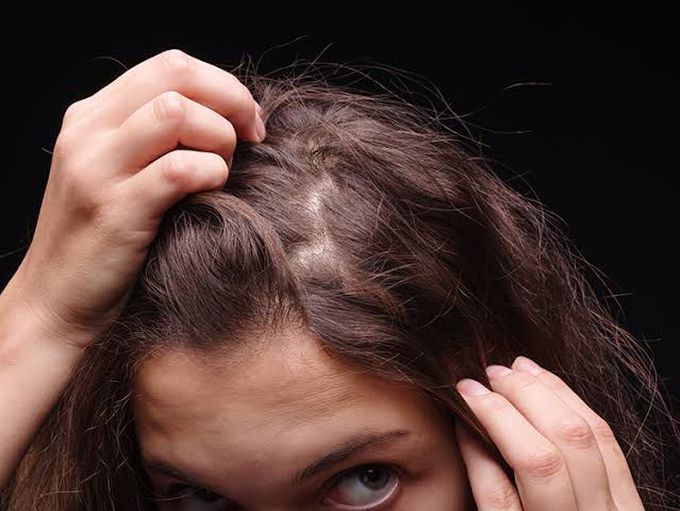 Sign and symptoms of hair pulling disorder