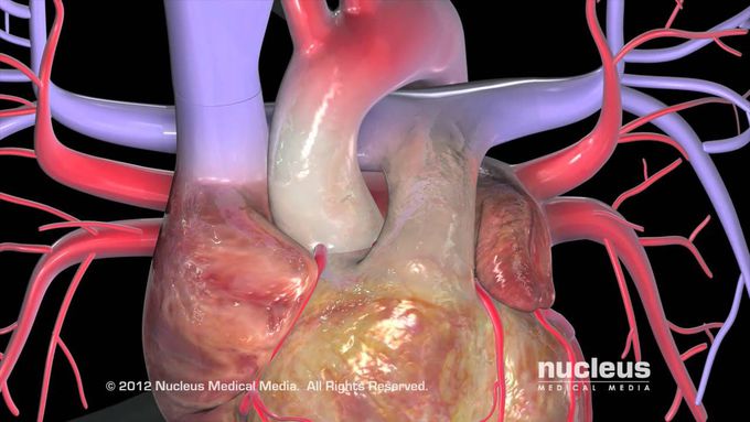 Coronary Artery Bypass Graft (CABG)
