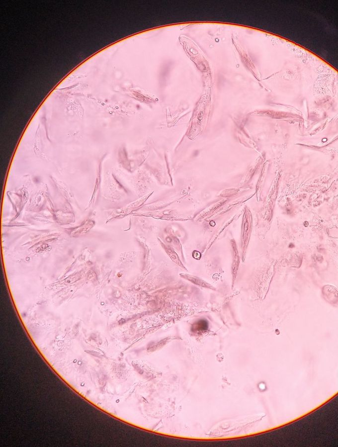 Epithelial cells in urine